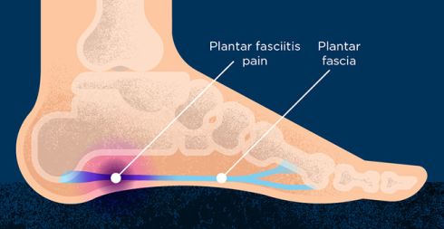 Plantar Fasciitis and riding boots